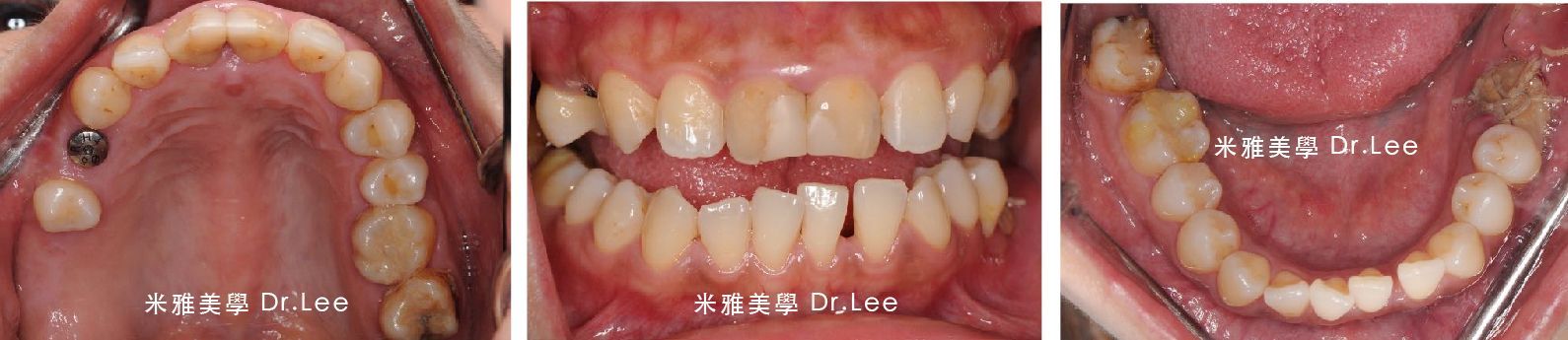 A close up of a person 's mouth showing their teeth.