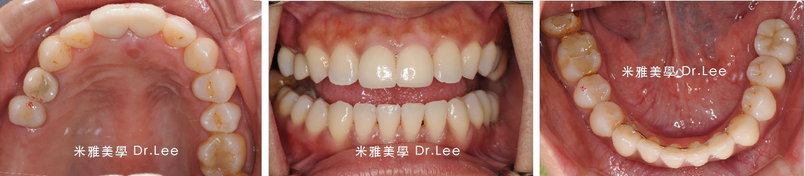 A collage of three pictures of a person 's teeth.