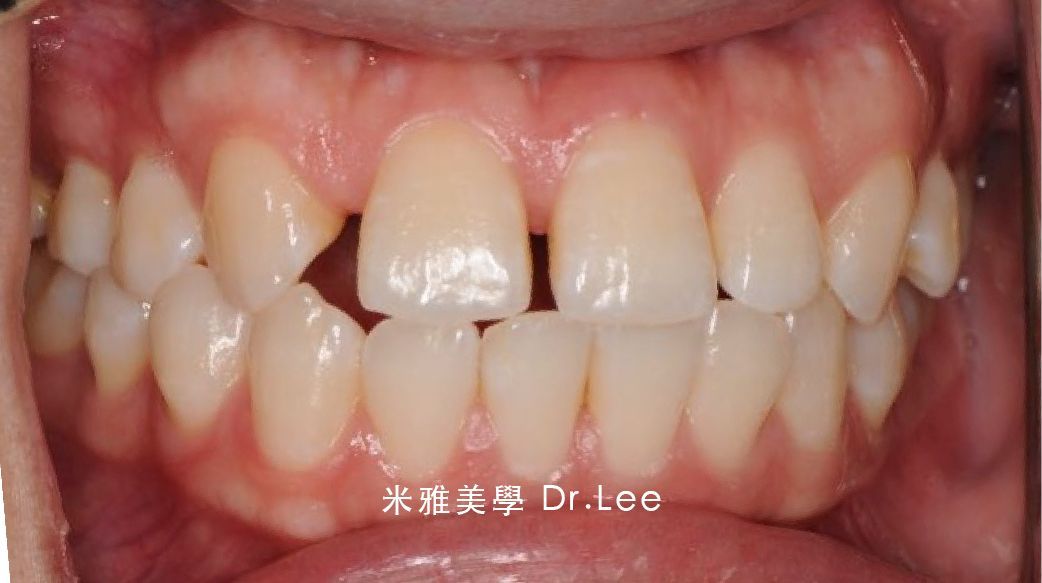 A close up of a person 's teeth with a red arrow pointing to a missing tooth.