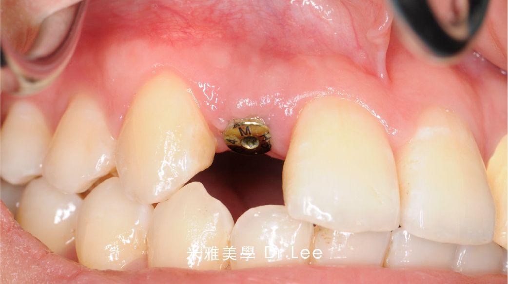 A close up of a person 's mouth with a tooth missing.