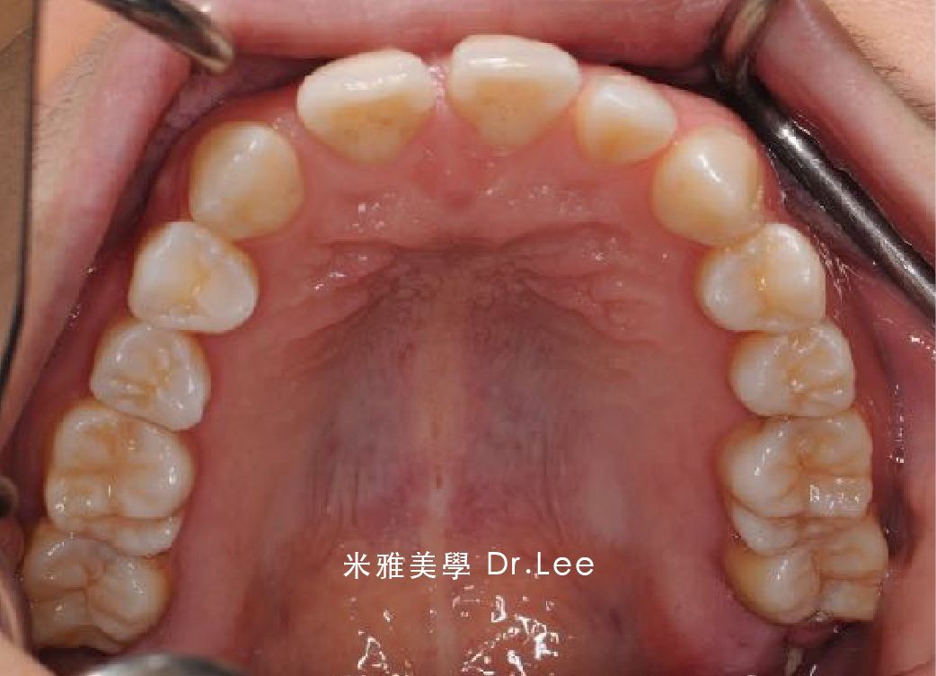 A close up of a person 's teeth with chinese writing on it