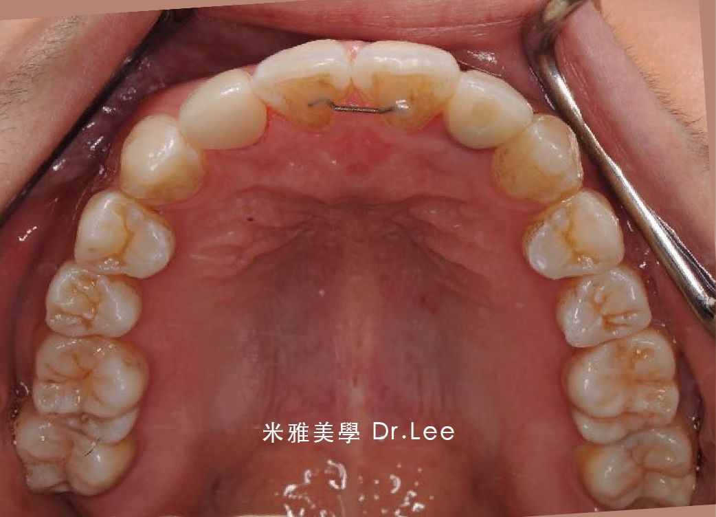A close up of a person 's teeth with chinese writing on it