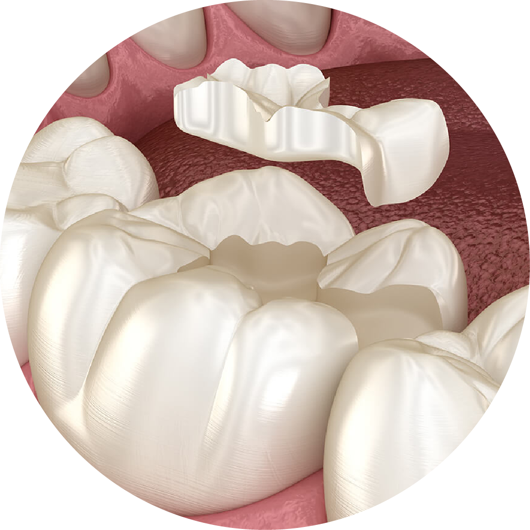 A close up of a tooth with a filling in it.