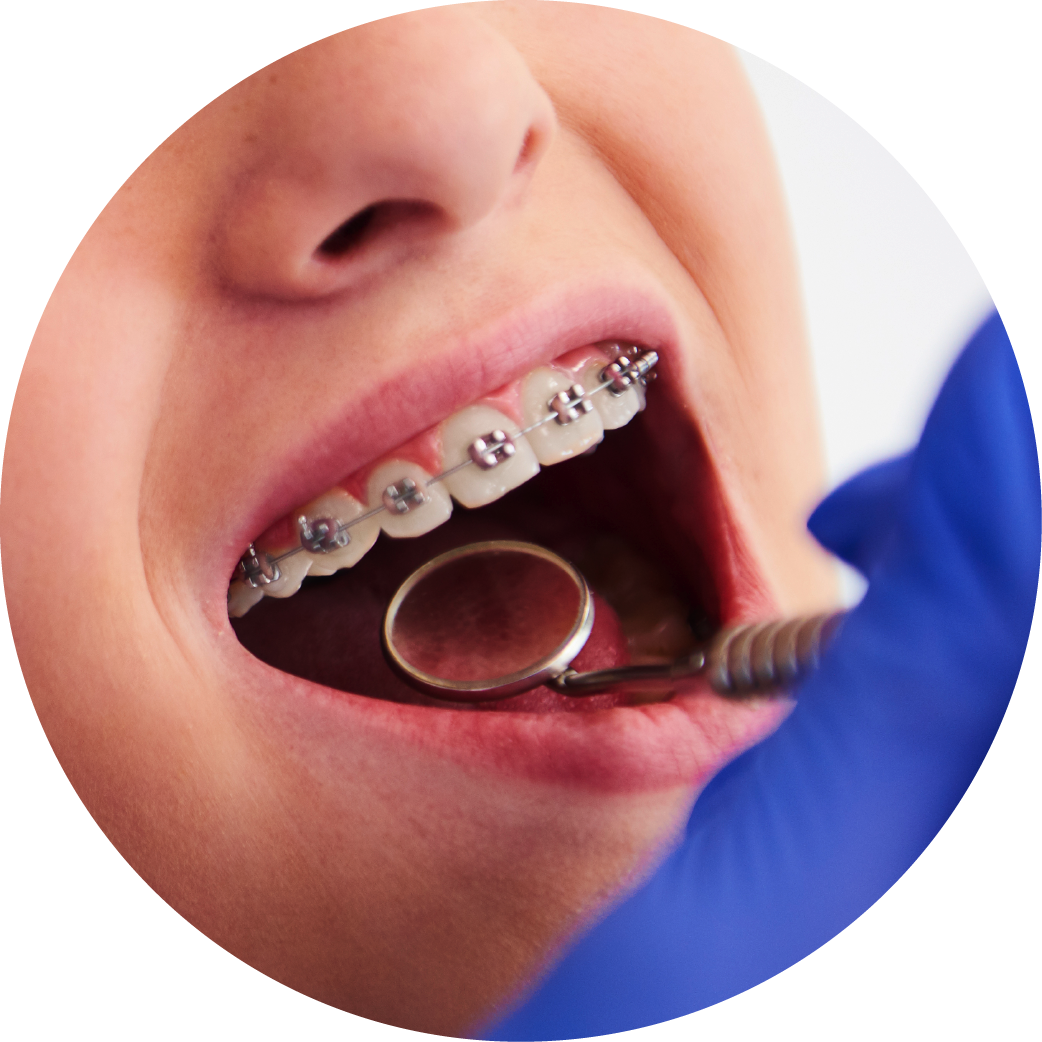 A person with braces is getting their teeth examined by a dentist