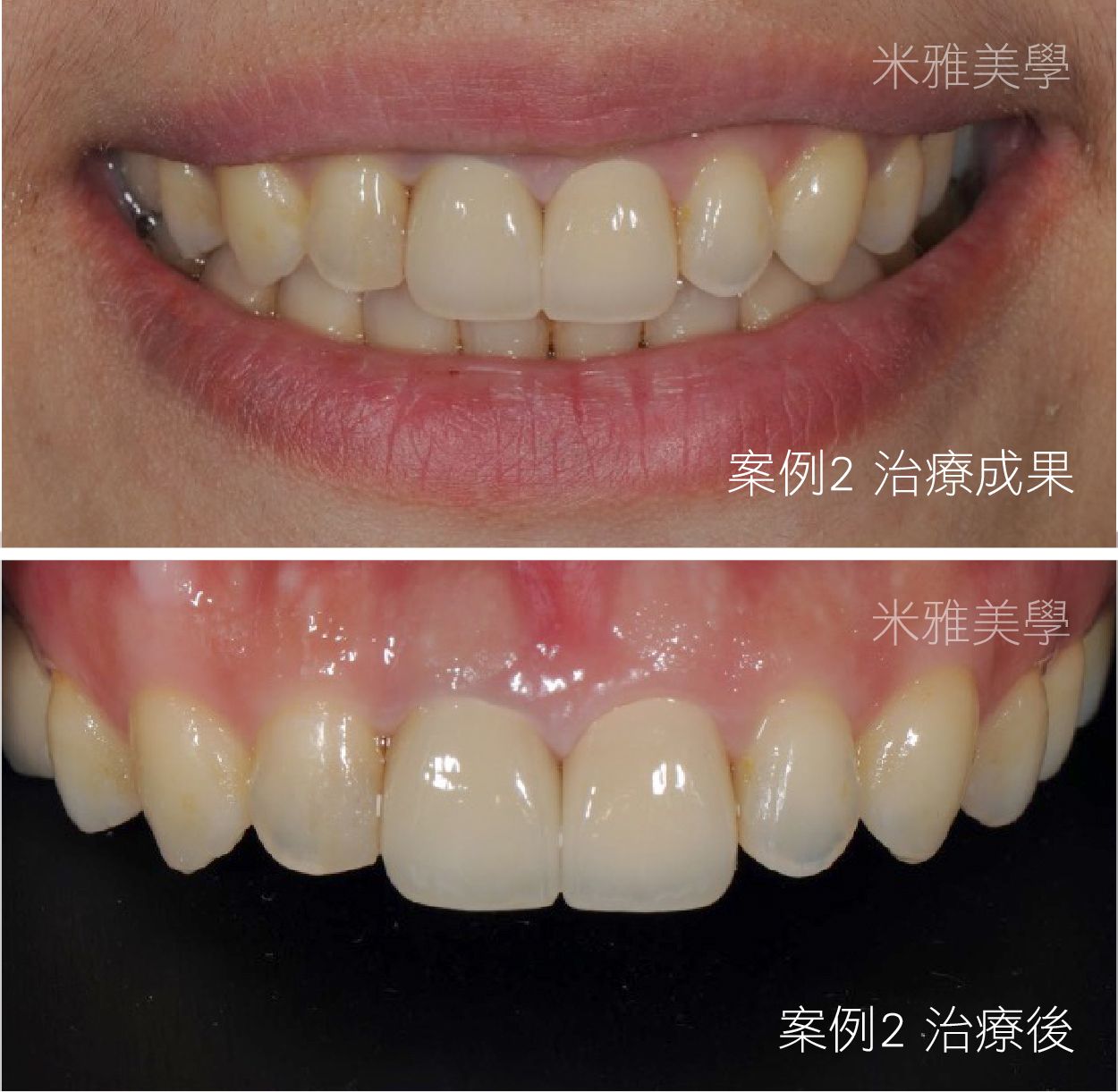 A before and after picture of a person 's teeth