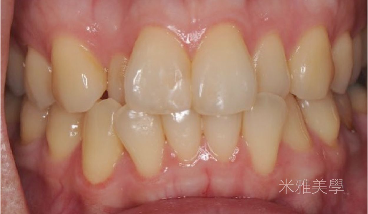 A close up of a person 's teeth and gums.