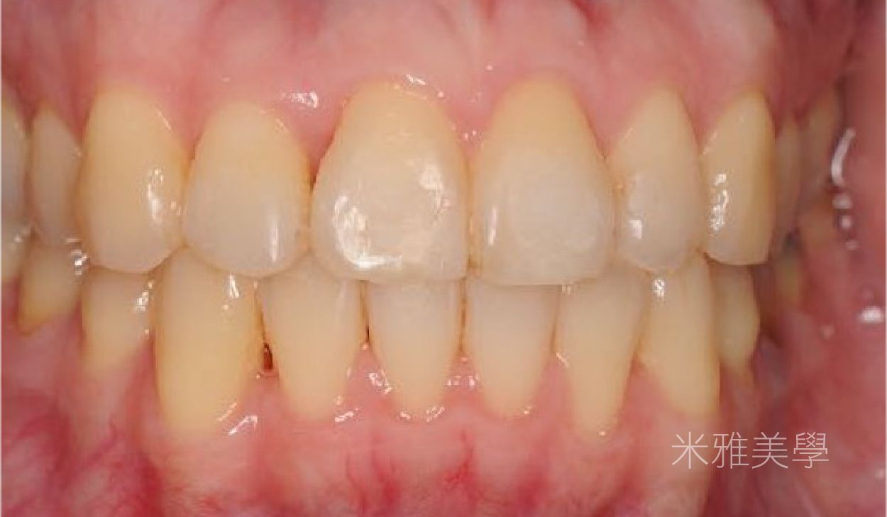 A close up of a person 's teeth and gums.