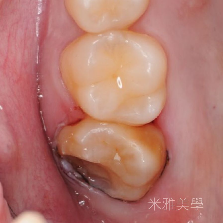 A close up of a tooth with chinese writing on it