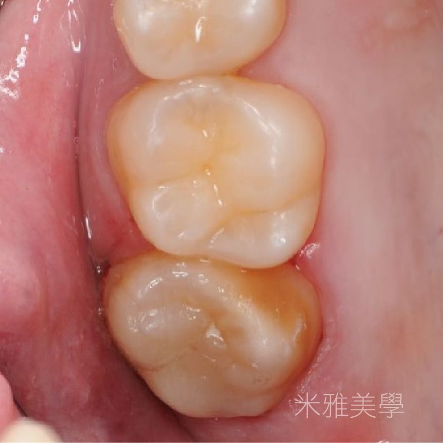 A close up of a tooth with chinese writing on it