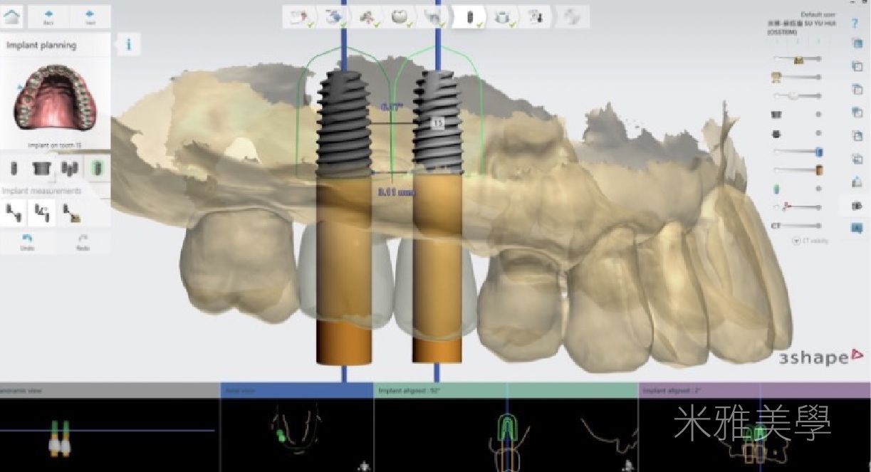 A computer screen shows a 3d model of a person 's teeth and gums.