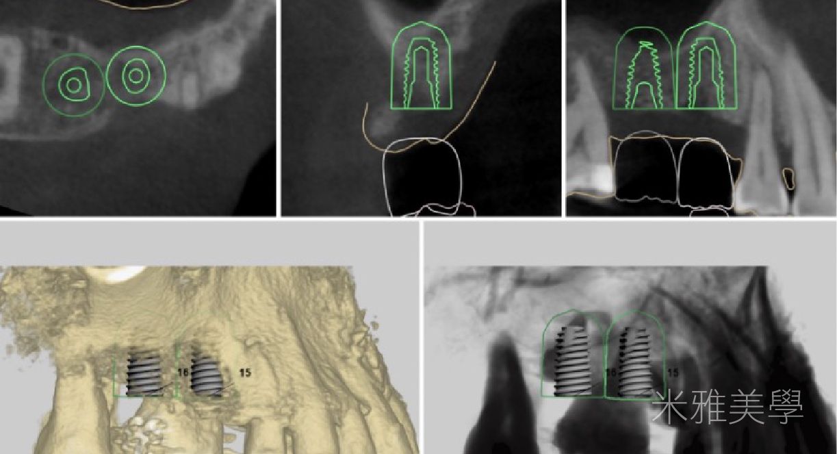 A collage of four images of a person 's teeth and gums.