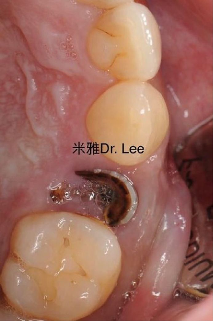A close up of a tooth with dr. lee written on it