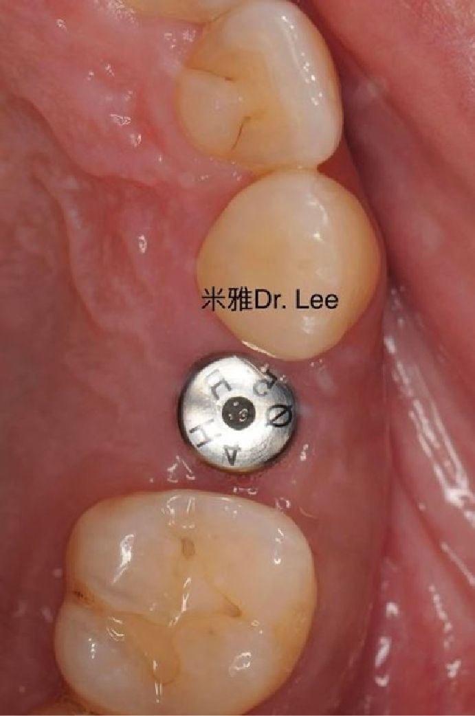 A close up of a tooth with the name dr. lee on it