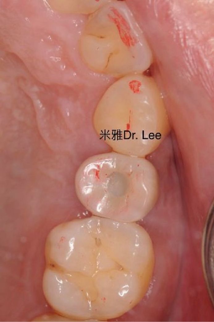 A close up of a person 's teeth with dr. lee written on the bottom