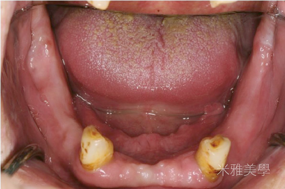 A close up of a person 's mouth with missing teeth
