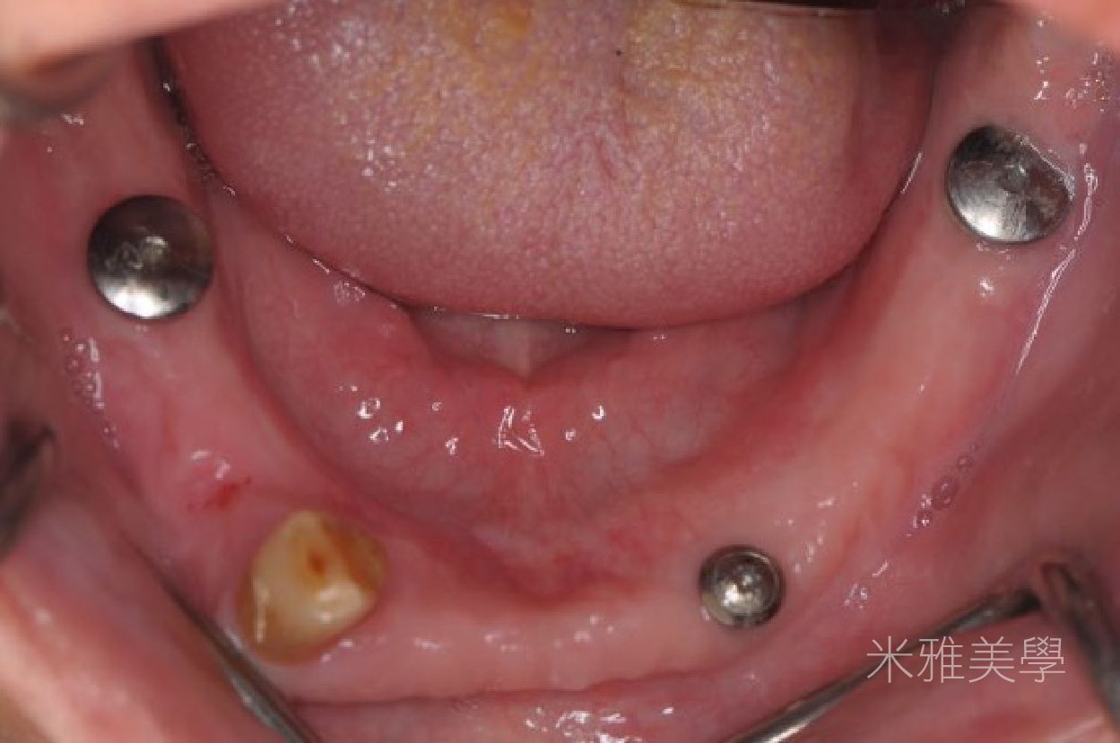 A close up of a person 's mouth with screws in it