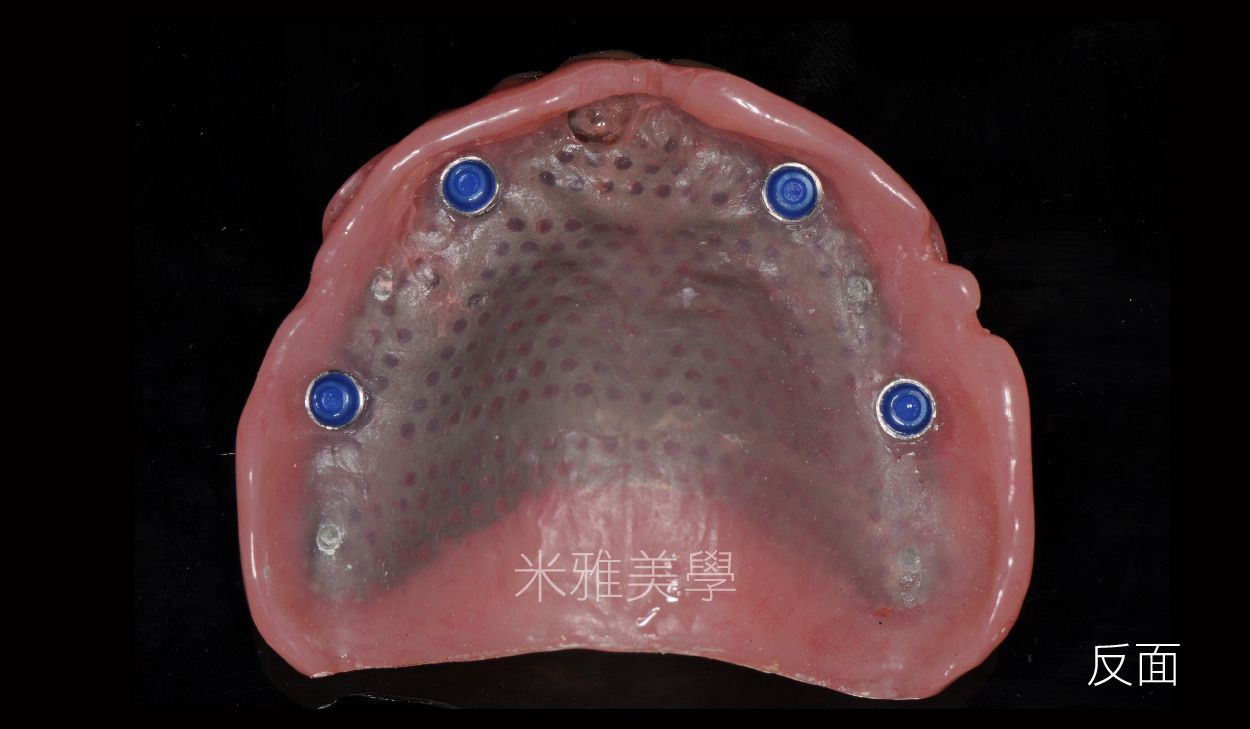 A close up of a denture with holes in it on a black background.