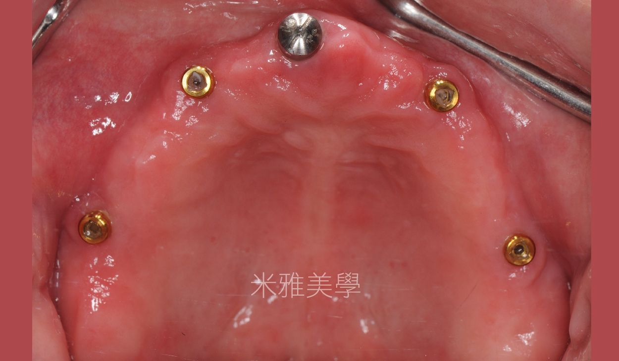 A close up of a person 's mouth with dental implants in it.