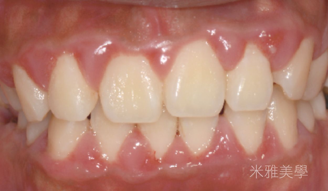 A close up of a person 's teeth and gums