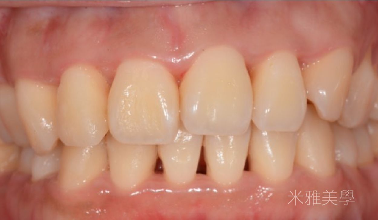 A close up of a person 's teeth and gums.