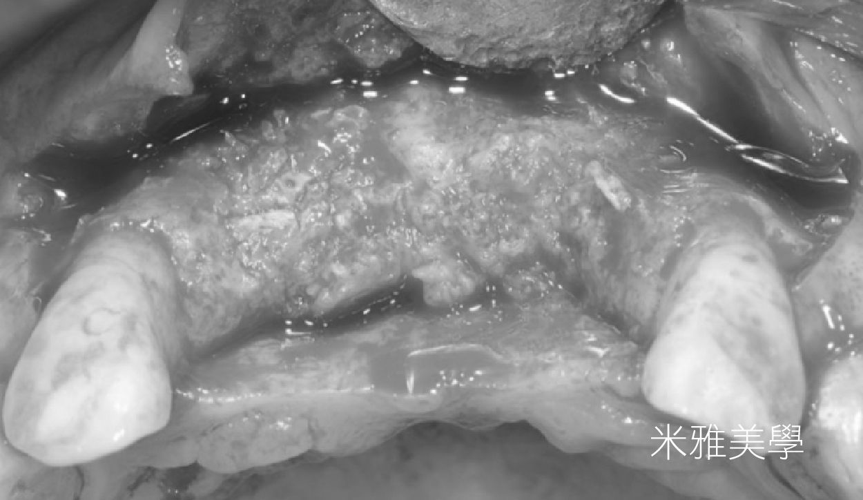 A black and white photo of a person 's mouth and teeth.