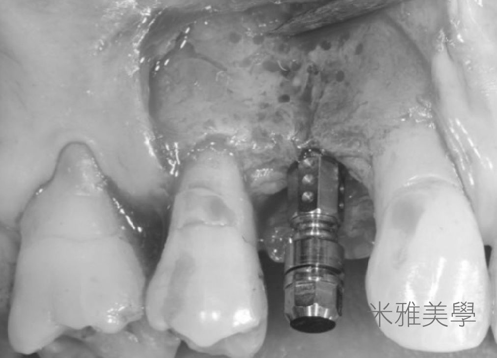 A black and white photo of a dental implant in a person 's mouth.