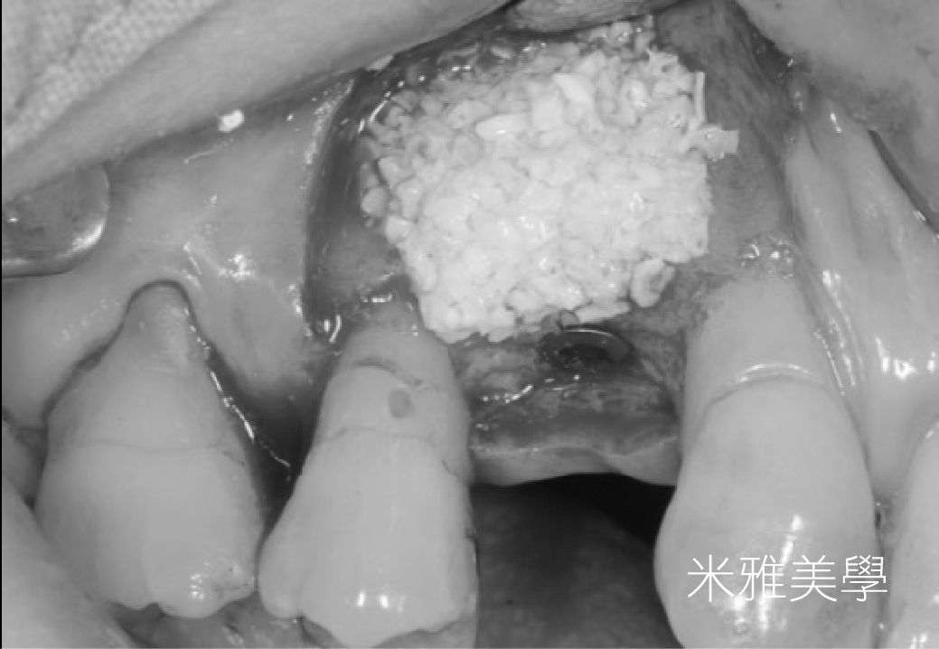 A black and white photo of a person 's mouth with a tooth missing.