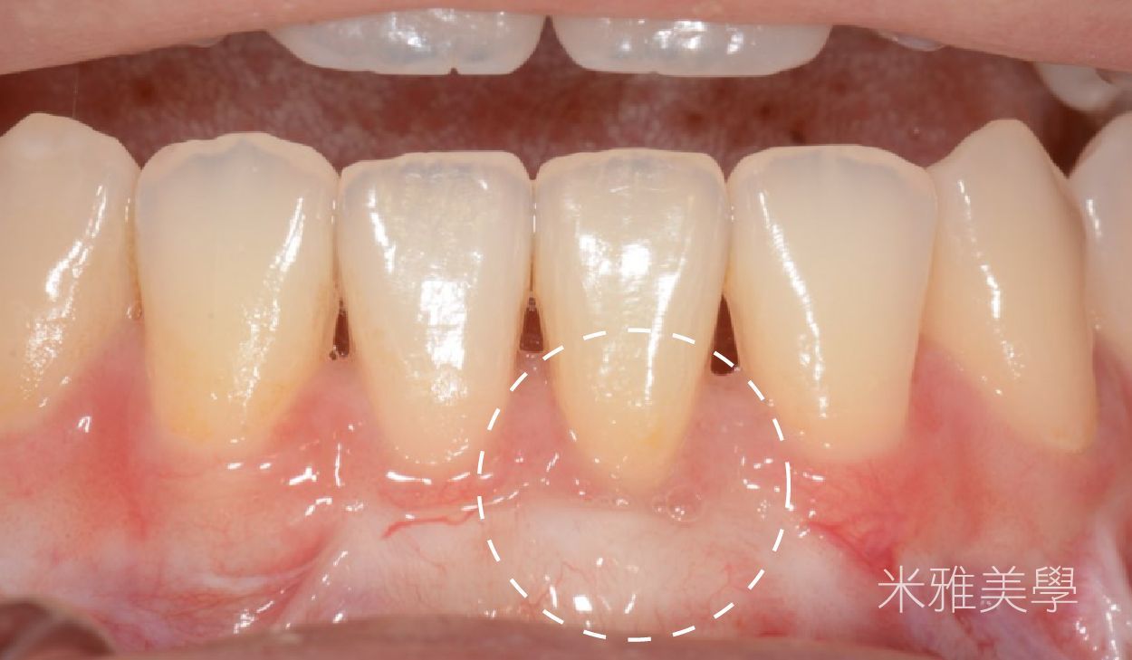 A close up of a person 's teeth and gums.