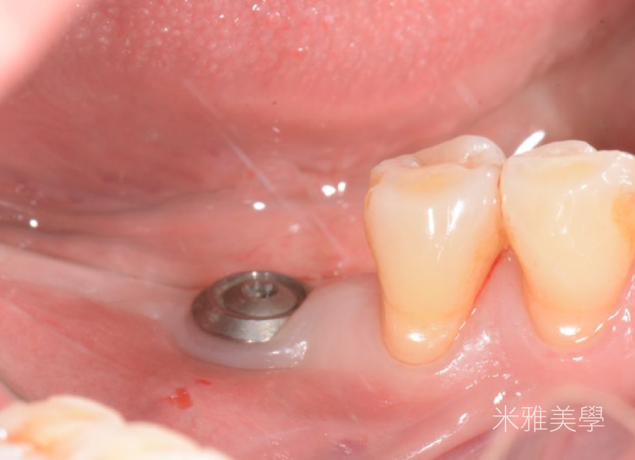 A close up of a person 's mouth with a dental implant in it