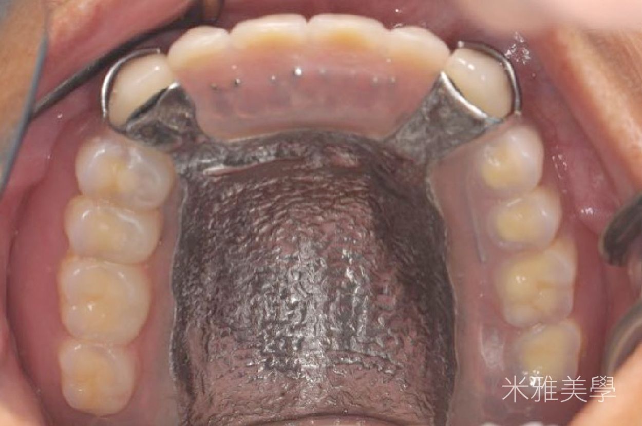 A close up of a person 's mouth with a metal brace on their teeth.