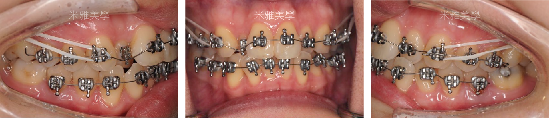 A close up of a person 's mouth with braces on their teeth.