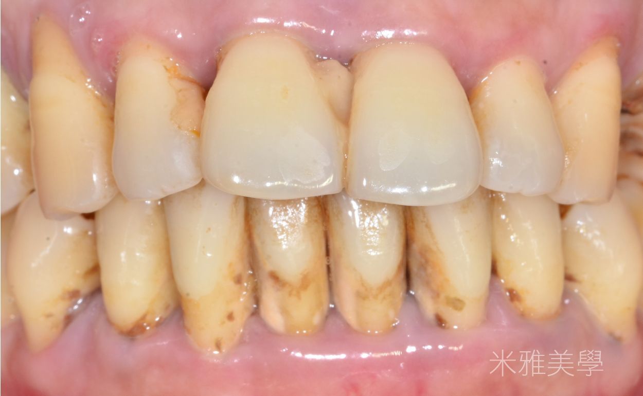 A close up of a person 's teeth with a lot of plaque on them.