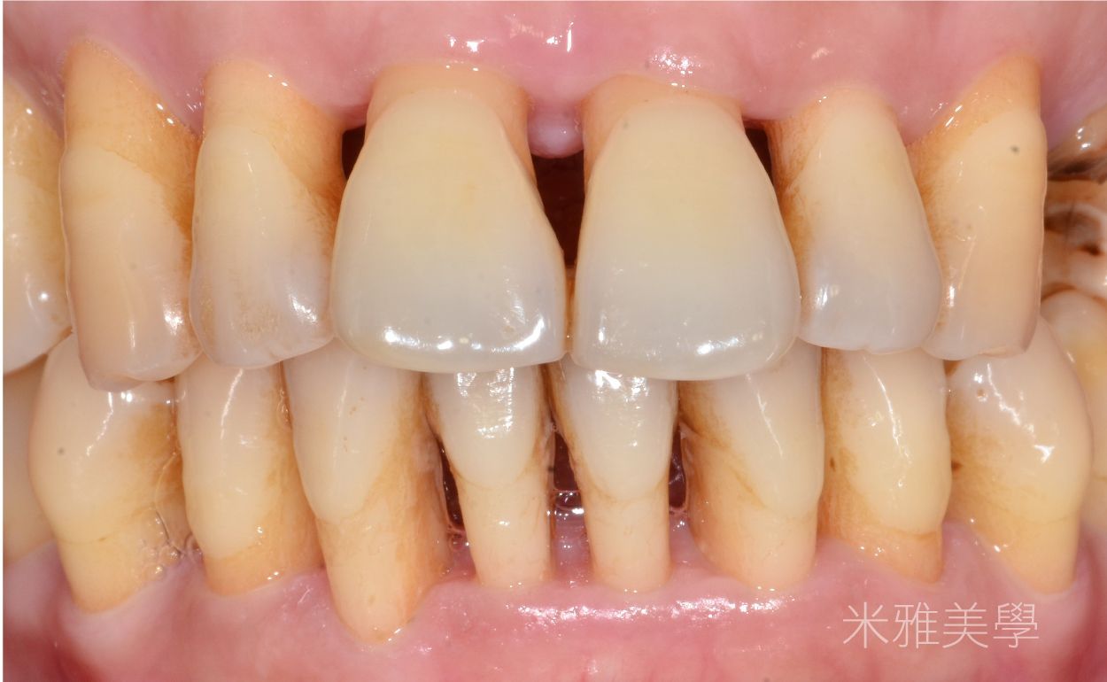 A close up of a person 's teeth with a missing tooth.