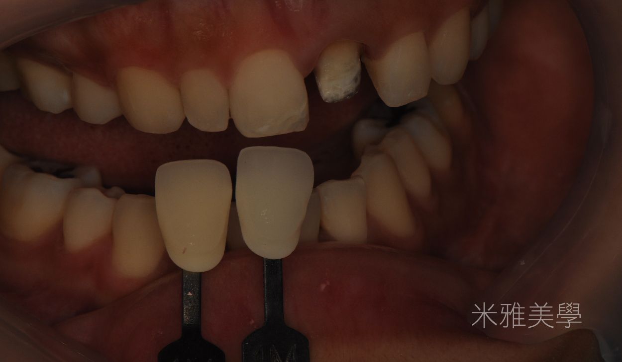 A close up of a person 's teeth with two tooth shades in front of them.