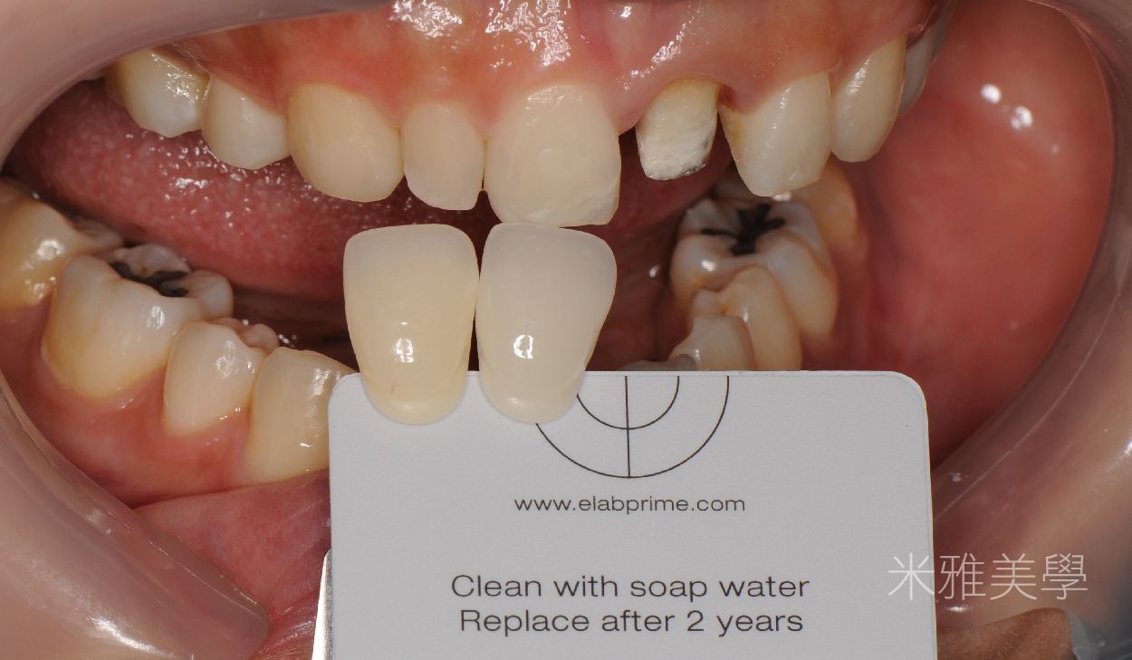 A close up of a person 's mouth with a card that says clean with soap water replace after 2 years