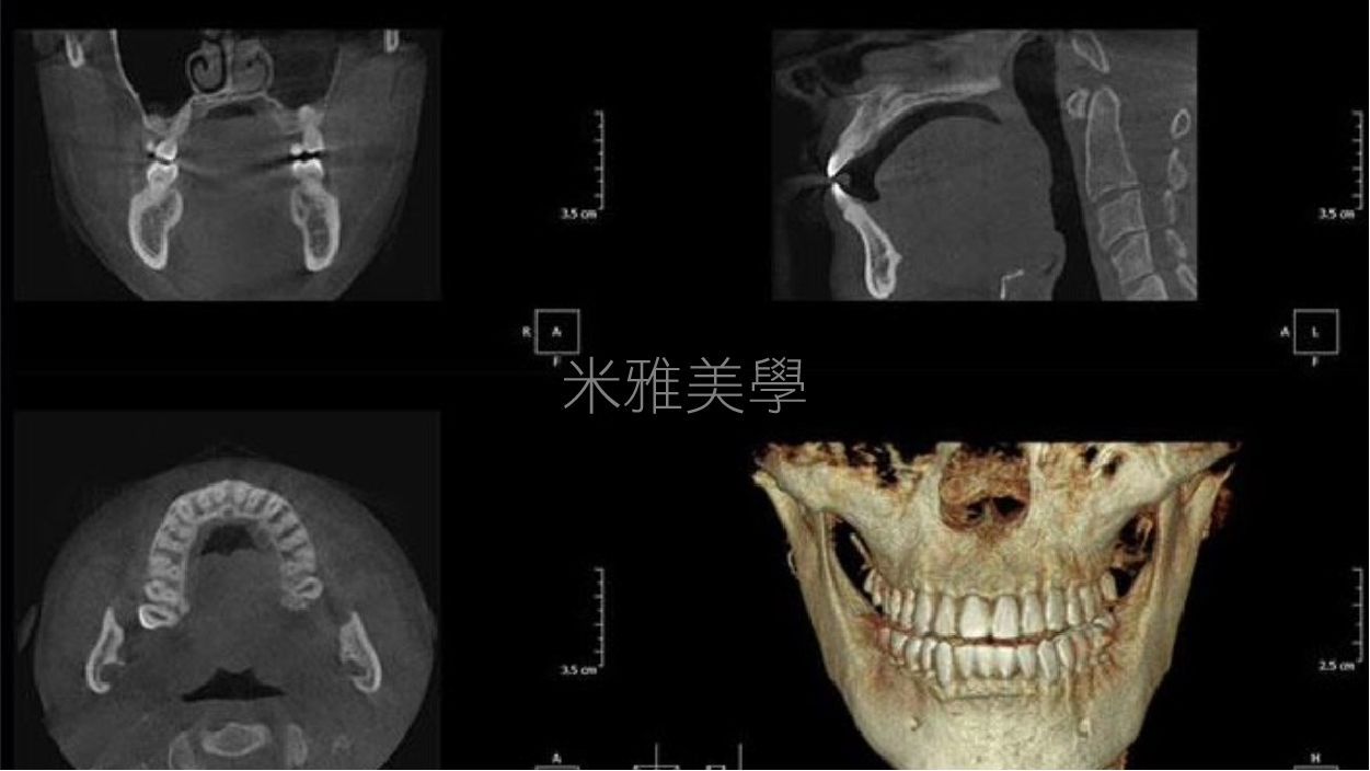 A ct scan of a person 's skull and teeth.