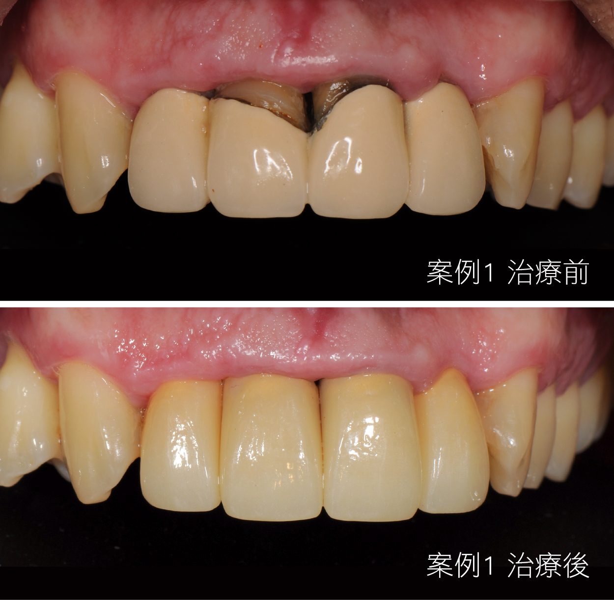 A before and after picture of a person 's teeth