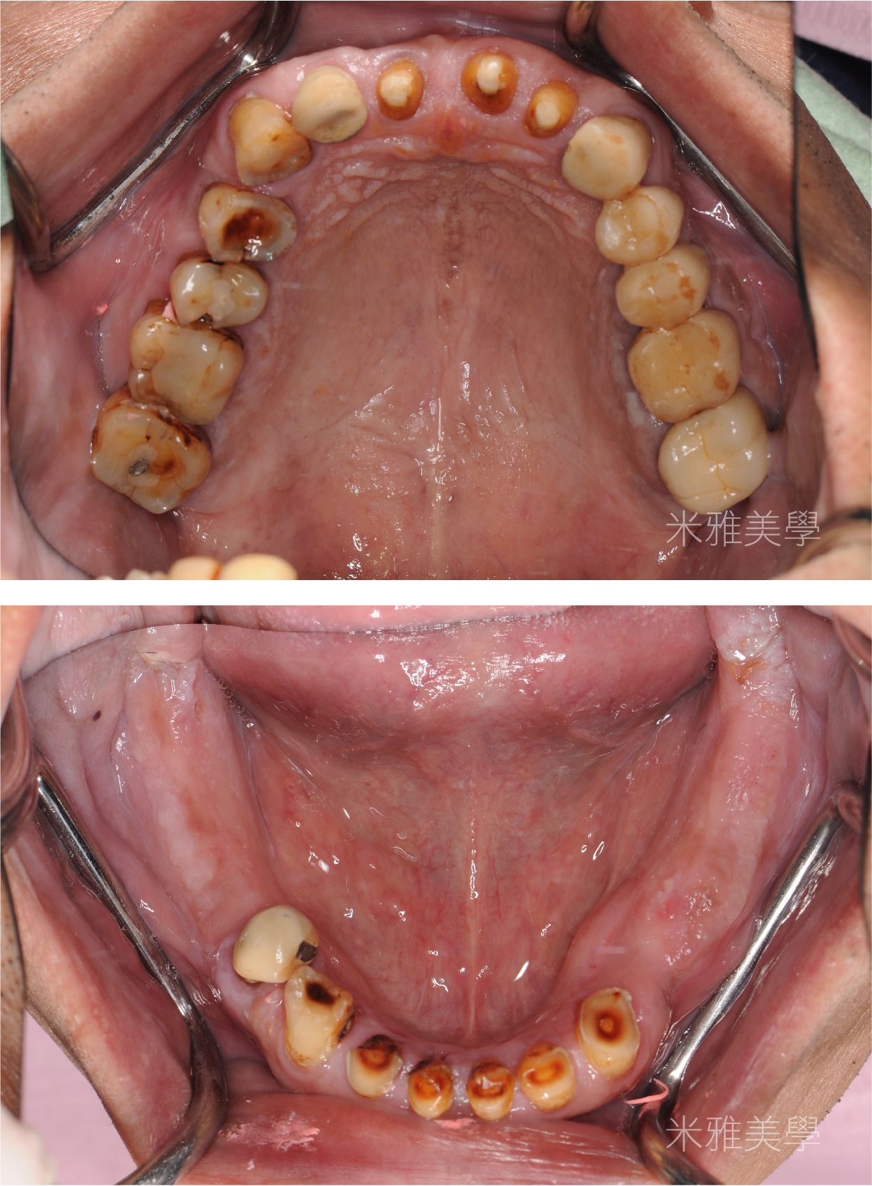A before and after picture of a person 's teeth