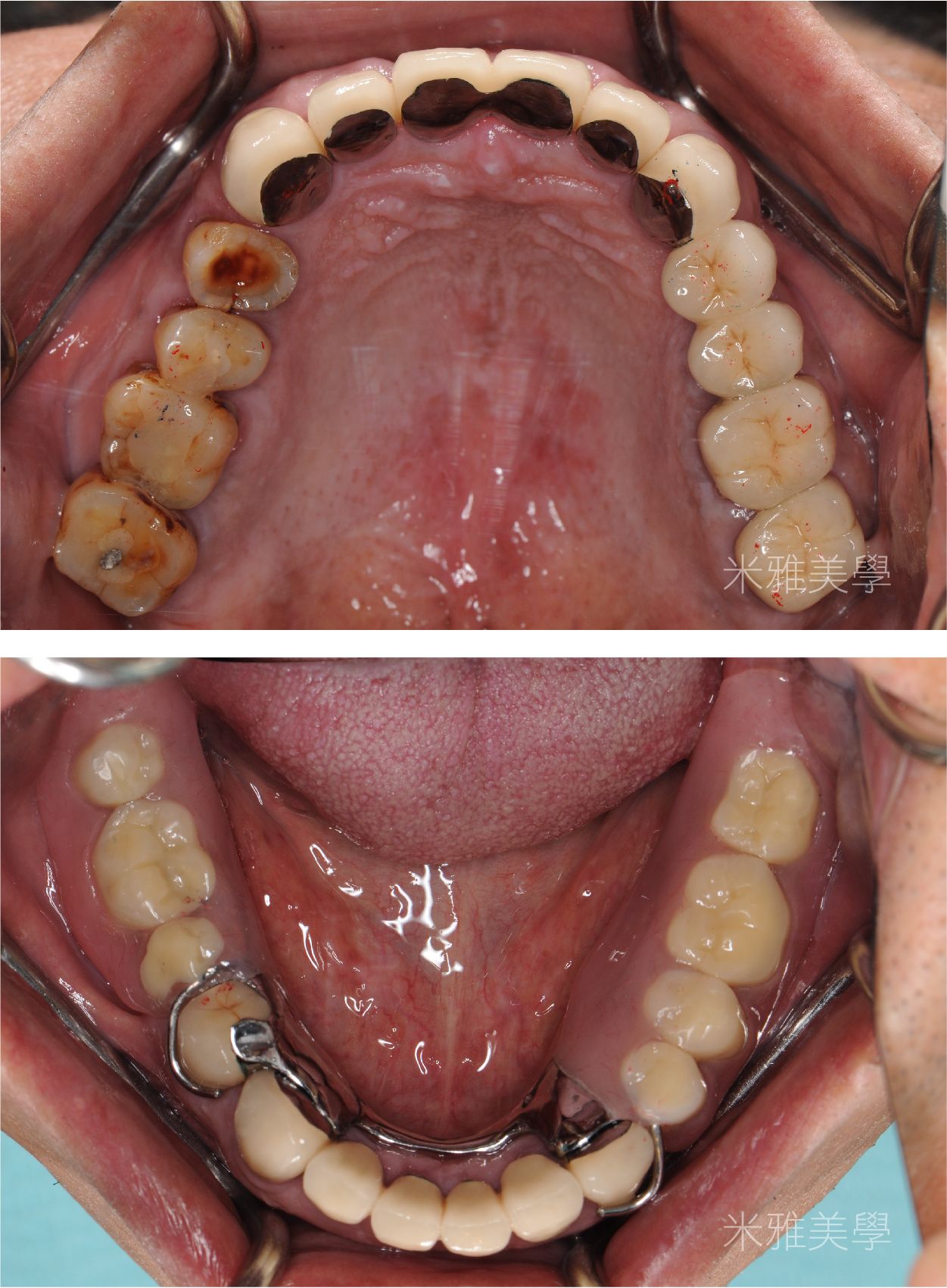 A before and after picture of a person 's teeth