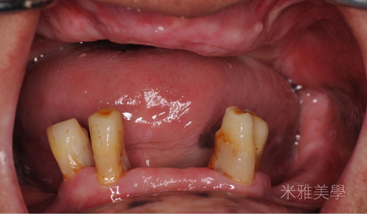 A close up of a person 's mouth with missing teeth.