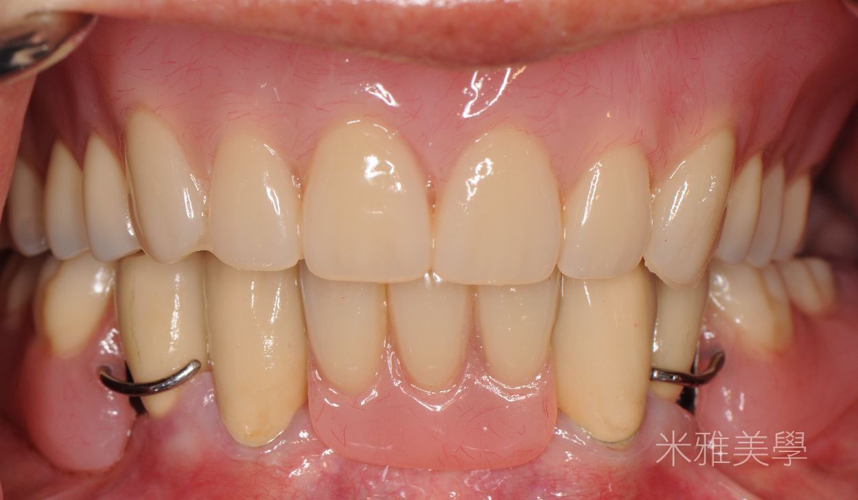 A close up of a person 's teeth with braces on them.