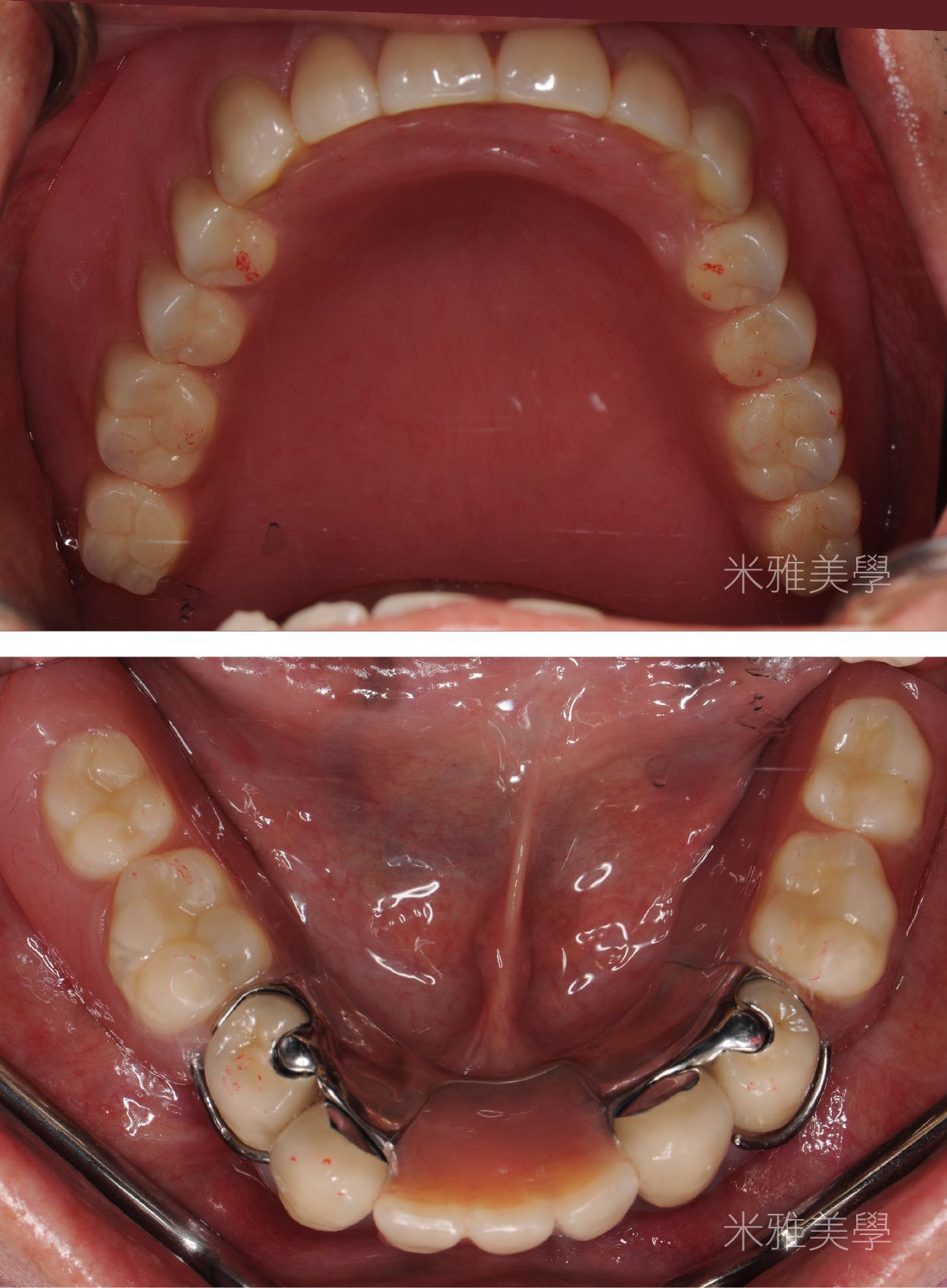 A before and after picture of a person 's teeth