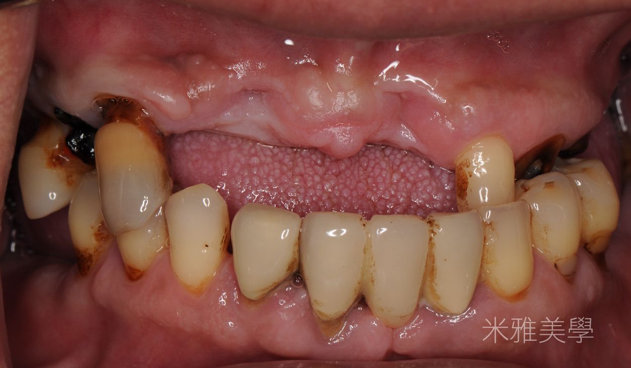 A close up of a person 's mouth with a lot of teeth missing.