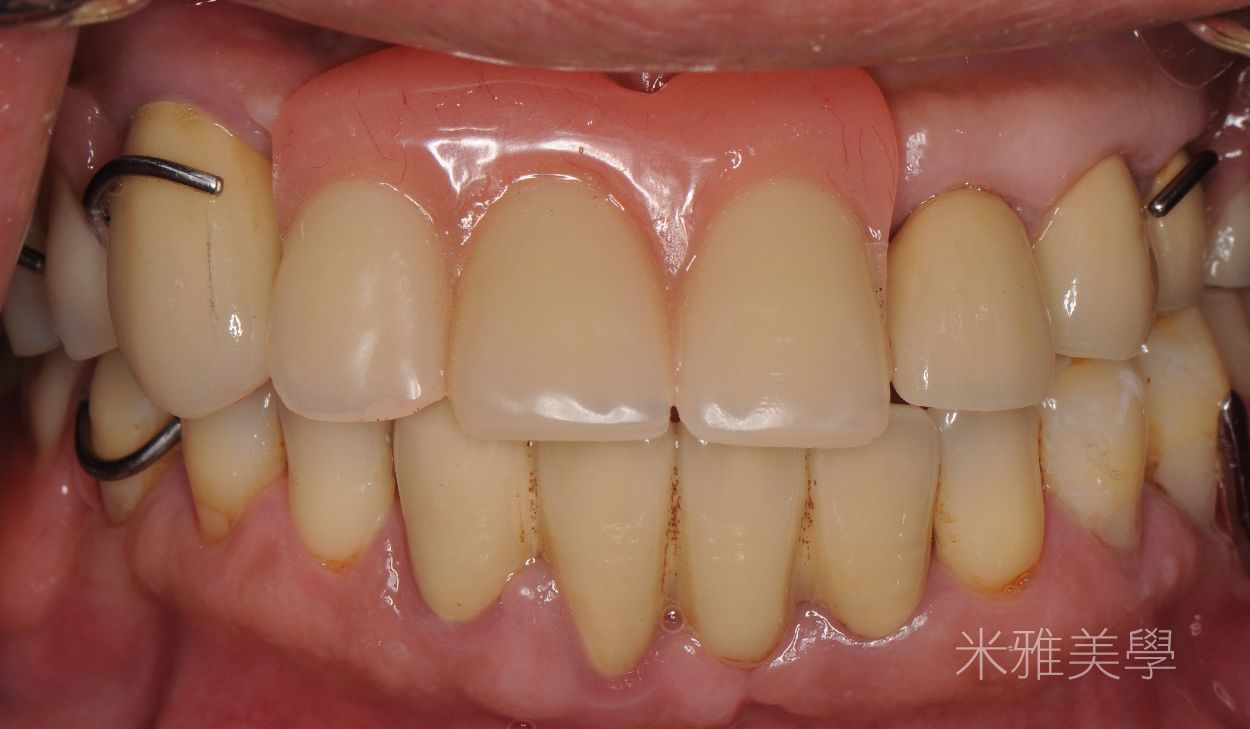 A close up of a person 's teeth with braces on them.