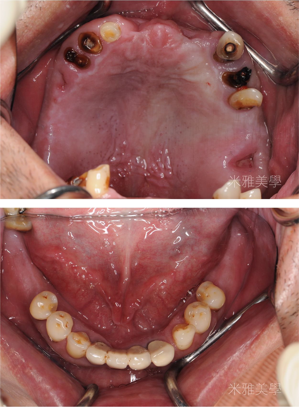 A before and after picture of a person 's mouth with missing teeth.