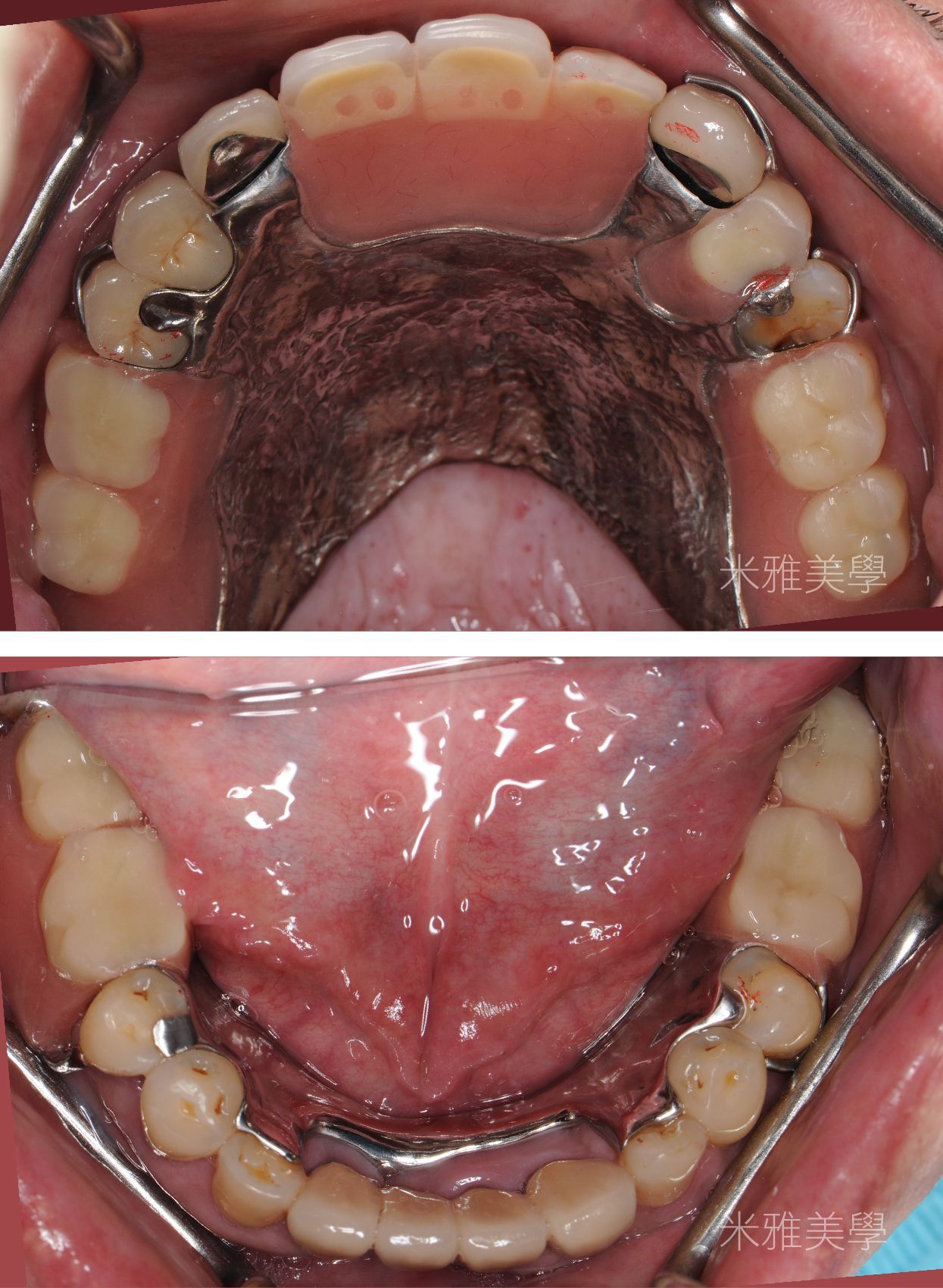 A close up of a person 's mouth with teeth and braces