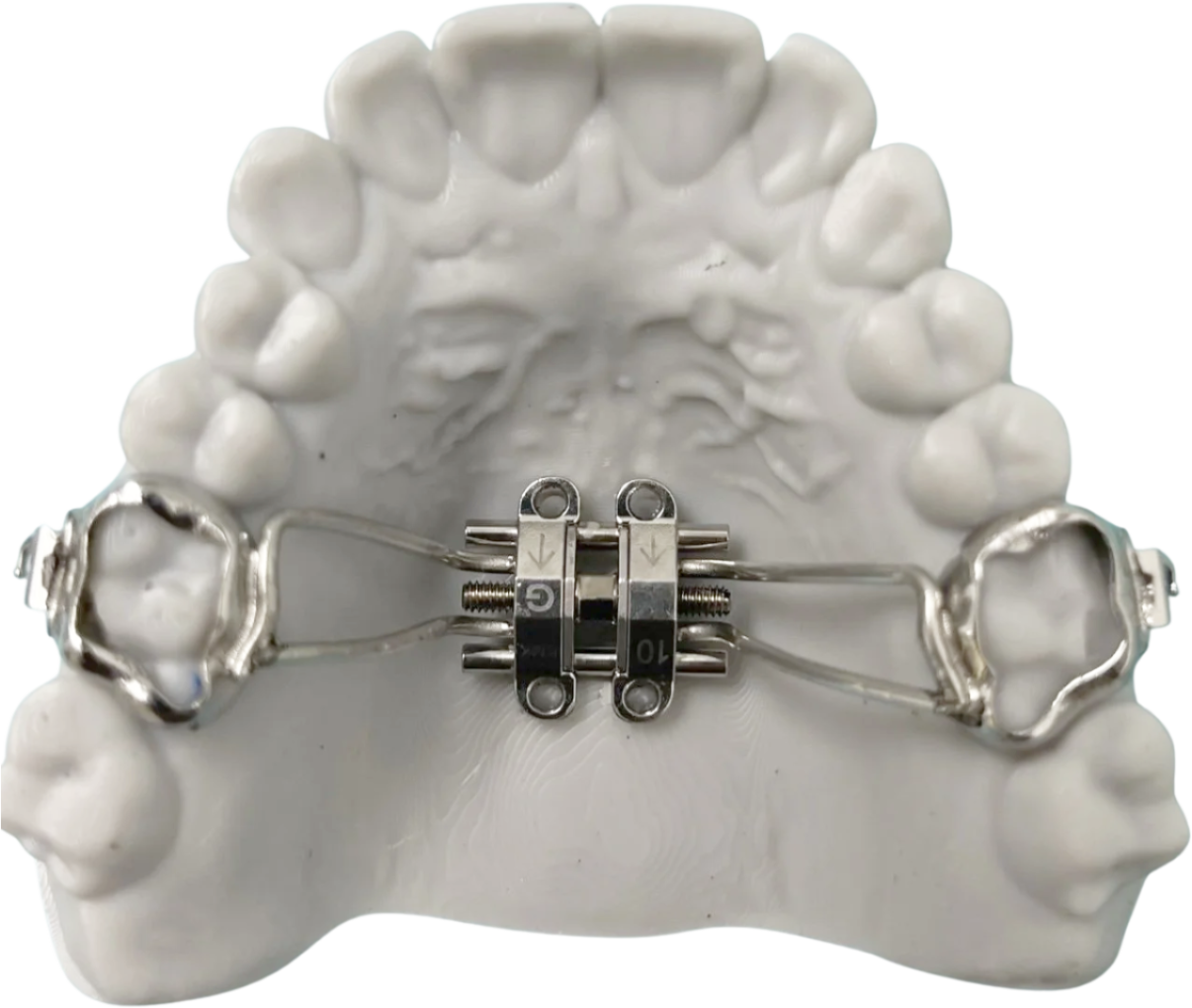 Dental retainer with metal bands attached to a white upper tooth mold