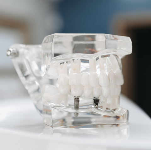 Dental implant at Rand Dental - featured services