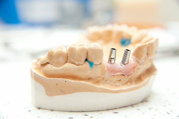 Dental Implant Model — Spokane, WA — Dr. Michael Readel, D.D.S.