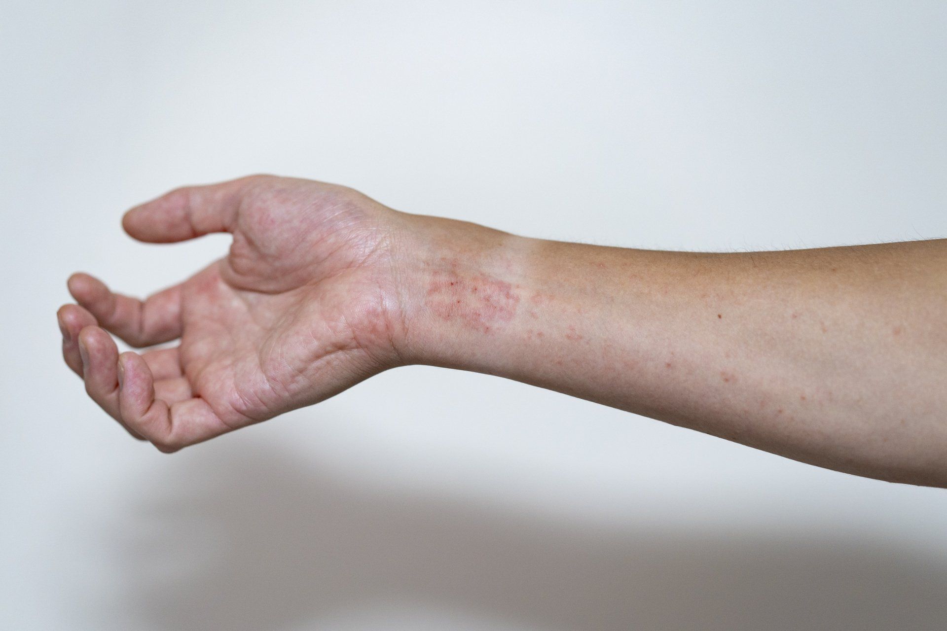 Médico para dermatite atópica no RJ Médico para dermatite atópica no Rio de Janeiro
